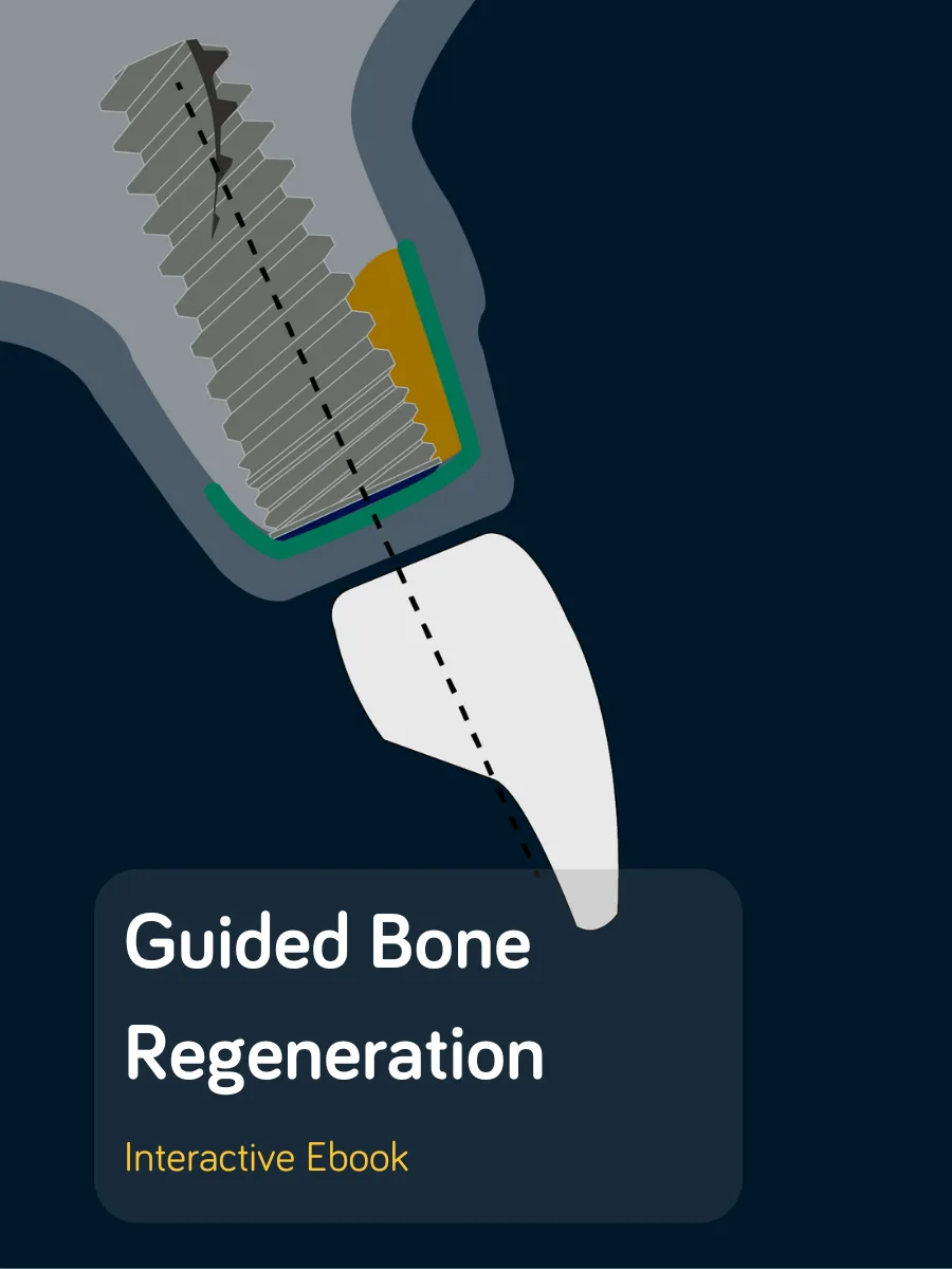 The 2026 interactive Guided Bone Regeneration ebook cover: a flat illustration of an implant, graft and membrane.